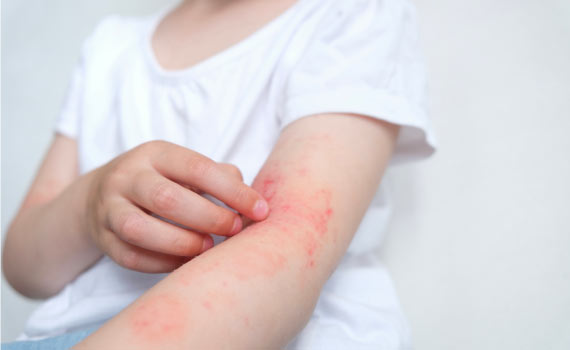 Allergies in woman hand white t-shirt